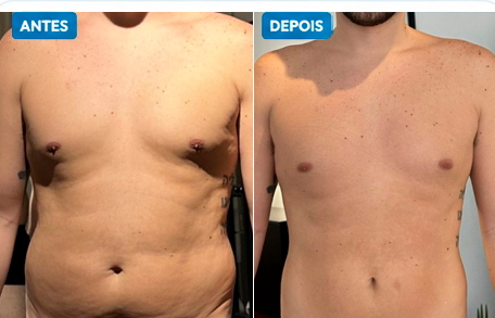 Comparação antes e depois do paciente Marcos A.